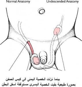 الخصية المعلقة قد تؤدي إلي العقم أو حدوث سرطان