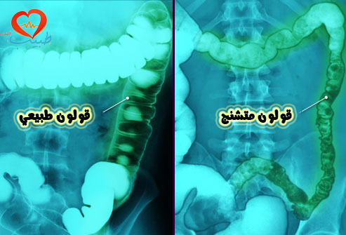 طبيب العرب نسائية الم حوض تشنج قولون