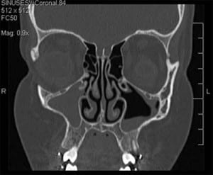 sinusitis_fig4