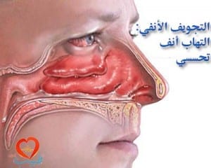 طبيب غ التهاب انف تحسسي