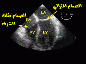 echocardiogram
