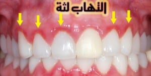 طبيب ع اسنان التهاب لثة