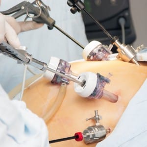 Laparoscopic-Hysterectomy-Reno