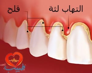 طبيب ع سنان التهاب لثة