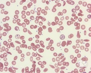 Sickle_cell_disease_RBC_morphology