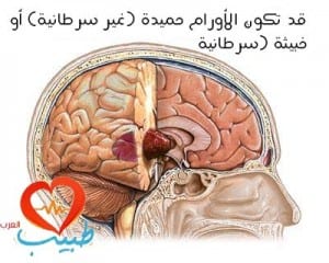 طبيب ع عصبية أورام الدماغ