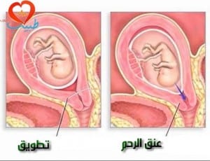 طبيب ع نسائية اجهاض علاج