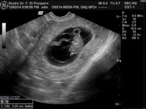 embryo-at-9-weeks-pregnant
