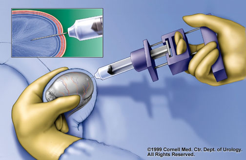 ضمور الخصيتين Testicular Atrophy شات جماعى لعقم الرجال فقط