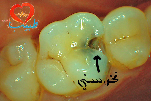 طبيب ع اسنان تسوس1