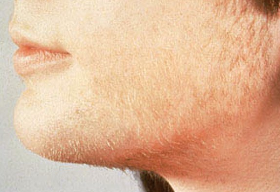 الشعرانية hirsutism