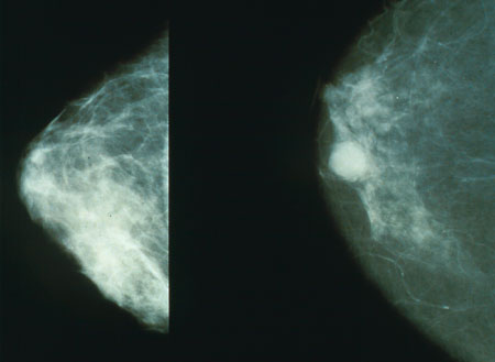 صورة أشعة سينية تبين شكل الورم السرطاني في الثدي(يمين) والثدي الطبيعي(يسار)