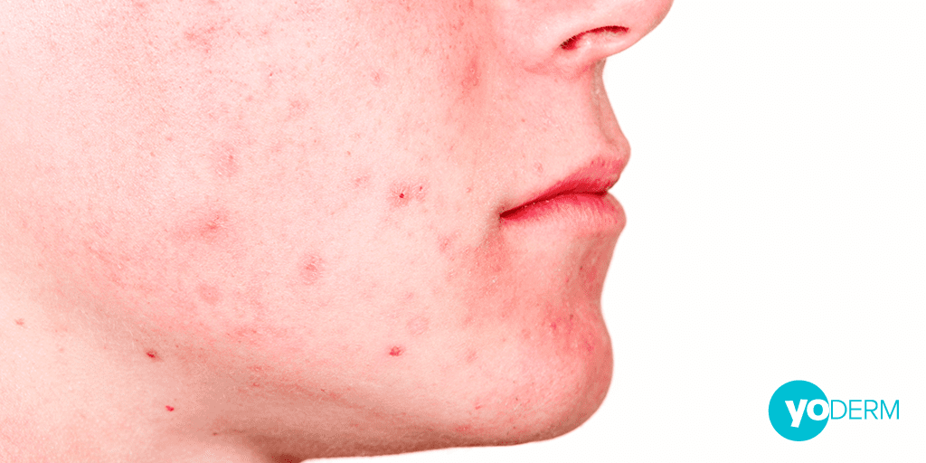 mild-acne