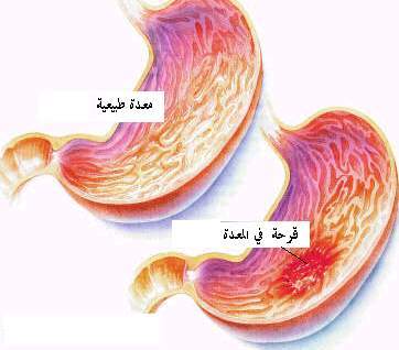 المعدة اعراض القرحة أعراض قرحة