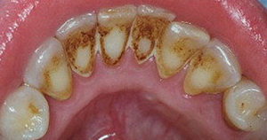 علاج تسوس الاسنان الصلبة يتطلب ازالة الاجزاء المتكلسة
