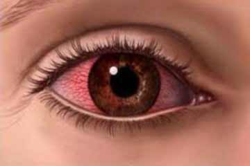 تغير لون العين يكشف ما قد تعانيه من أمراض