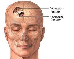 كسر الجمجمه