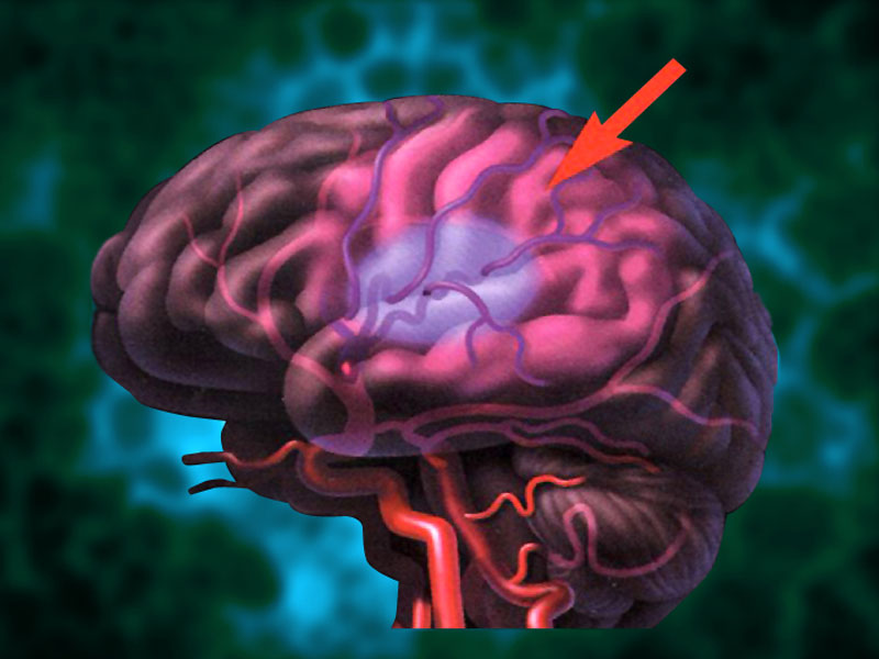 تبريد الدماغ يفيد بعلاج الجلطة الدماغية
