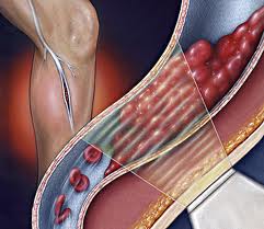 التخثر الوريدي قد يمتد من الساق ليصيب القلب و الرئتين