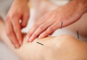 acupuncture-douleur-410