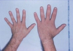 Acromegaly_hands