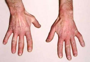 ظاهرة رينود ماهي وما اسبابها وعلاجها Raynaud's disease ؟