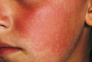 princ_rm_photo_of_fifth_disease_on_face