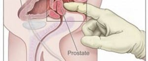 prostate-dre_f_600x250