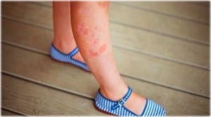 psoriasis_on_girls_leg