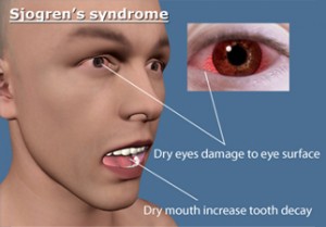 sjogrensyndrome