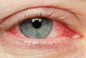 istock_photo_of_eye_with_redness