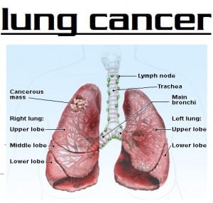 lung-cancer new