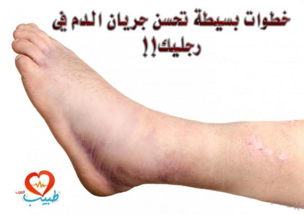 علامات تدلك علي عدم صلاحية الجبيرة (الجبس) متى يفك الجبس اعراض ما