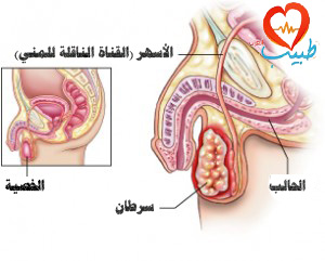 سرطان الخصية أسباب سرطان الخصية أعراض سرطان الخصية علاج سرطان الخصية