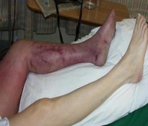 Deep-Vein-Thrombosis-Symptoms