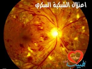 اعتلال الشبكية السكري Diabetic retinopathy