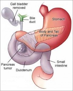 Pancreatic-Cancer3