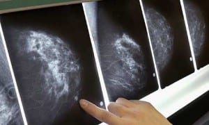 mammogram460