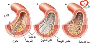 طبيب ع اوعية