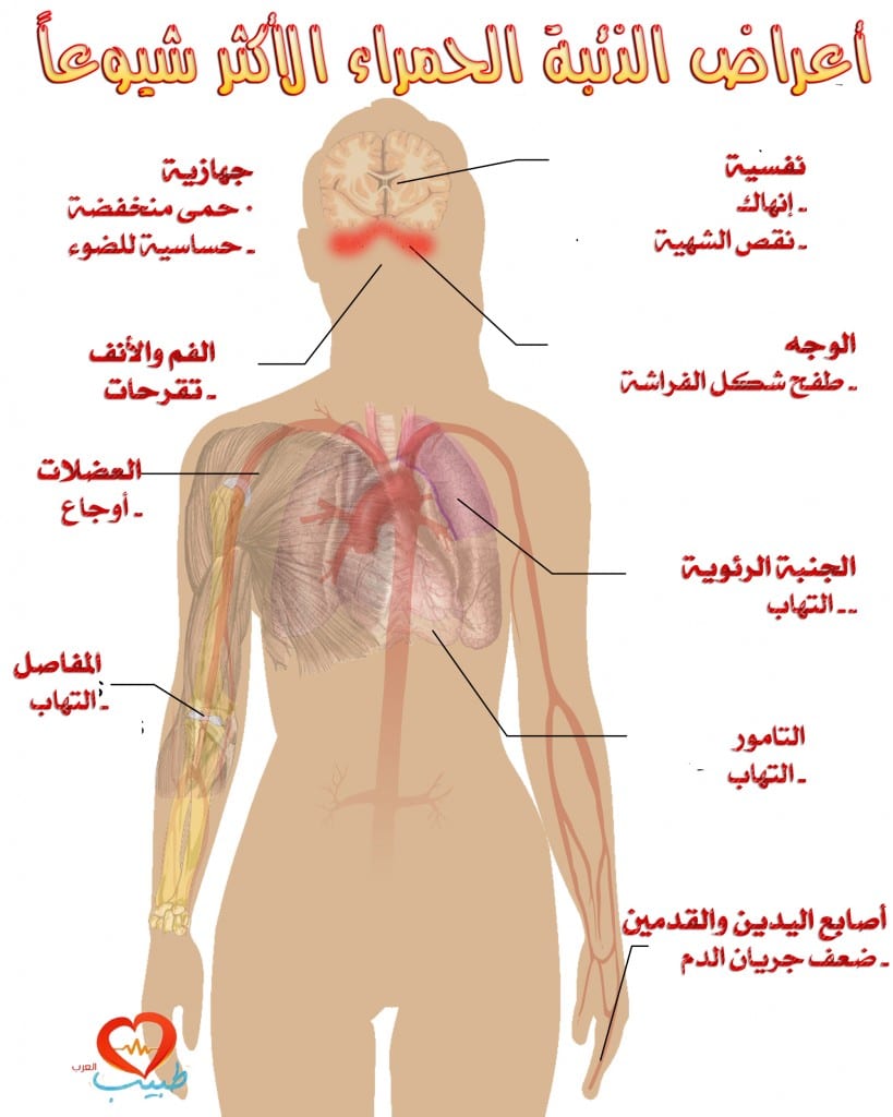 أعراض الذئبة الحمراء