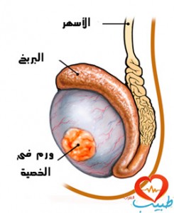 سرطان الخصية