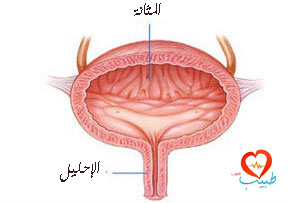 علاج التهابات المثانة البولية