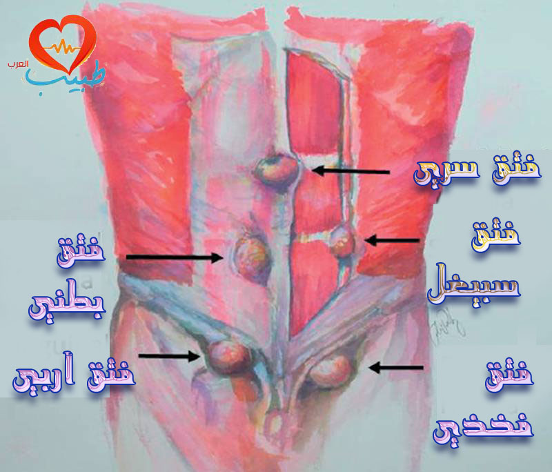 اعراض فتق البطن