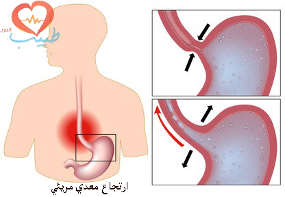الارتجاع المعدي المريئي الجزر ارتجاع المريء Gerd
