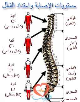 هل يوجد علاج للحبل الشوكي