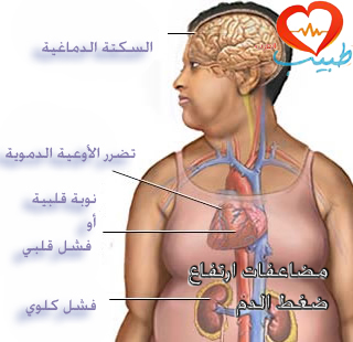 يتسبب تربية القطاتونيا الذابلة في ارتفاع ضغط الدم المفاجئ Sjvbca Org