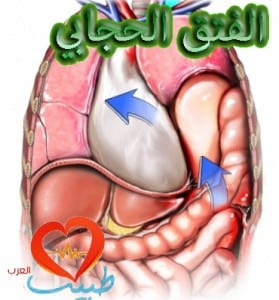 diaphragm_hernia