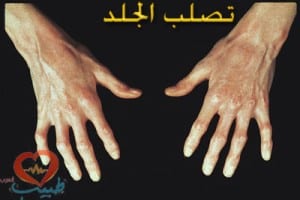 scleroderma-hand_jpg