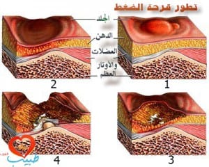 قرحة الضغط ( قرحة الفراش ) pressure ulcer