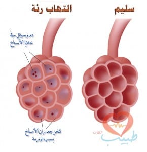 طبيب ع رئة 11